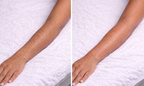 Forearm before and after professional waxing at Velora in Easley, SC