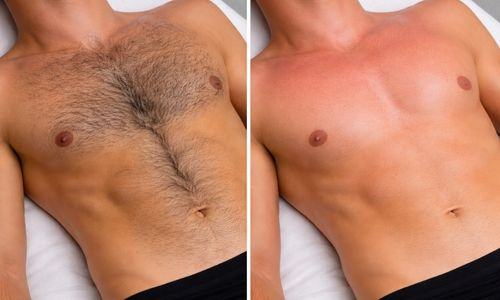 A man's chest before and after waxing at Velora in Easley, SC