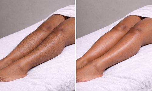 Legs before and after professional waxing at Velora in Easley, SC