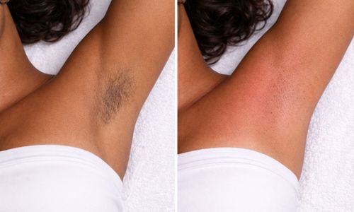 Underarm before and after waxing at Velora in Easley, SC